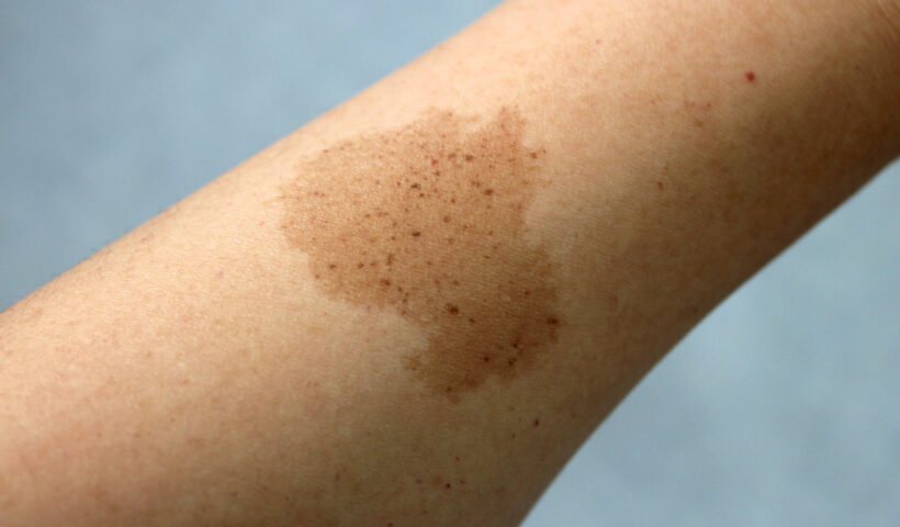 Decoding the Spiritual Meaning of Birthmarks